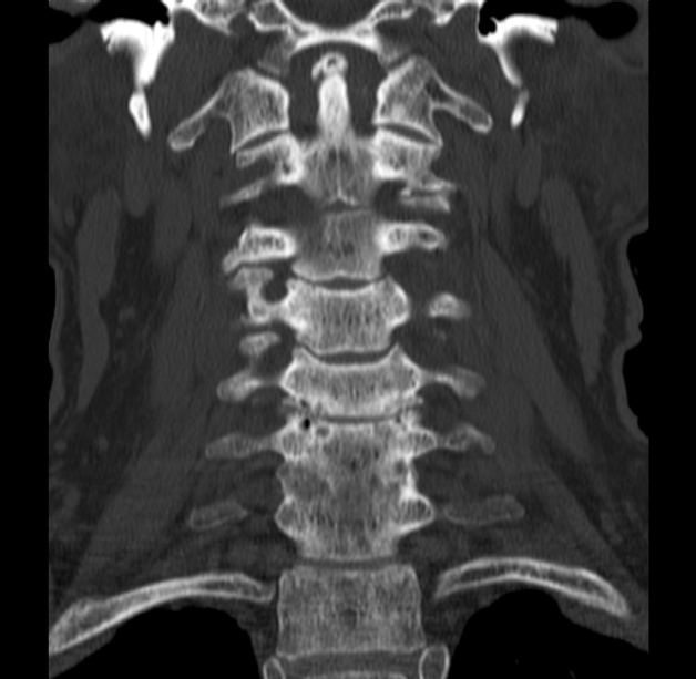 Anterior cervical postdiscectomy arthrodesis (Radiopaedia 32678-33646 Coronal bone window 27).jpg