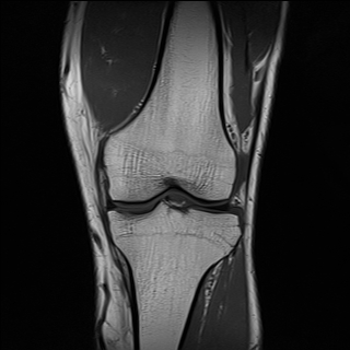 File:Anterior cruciate ligament full thickness tear (Radiopaedia 66268-75467 Coronal T1 10).jpg