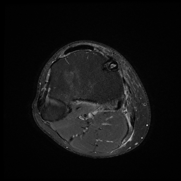 File:Anterior cruciate ligament graft tear and bucket-handle tear of medial meniscus (Radiopaedia 75867-87255 Axial PD fat sat 1).jpg