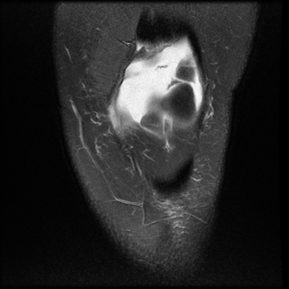 File:Anterior cruciate ligament tear, Wrisberg rip and bucket-handle tear of medial meniscus (Radiopaedia 75872-87266 Coronal PD fat sat 6).jpg