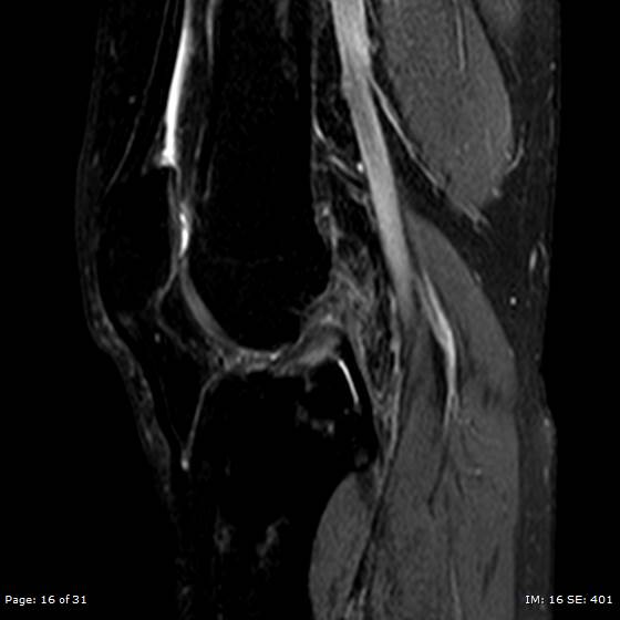 File:Anterior cruciate ligament tear (Radiopaedia 70783-80964 Sagittal STIR 16).jpg