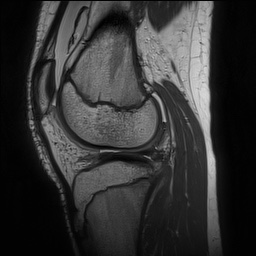 Anterior cruciate ligament tear - pediatric (Radiopaedia 62152-70260 Sagittal PD 113).jpg