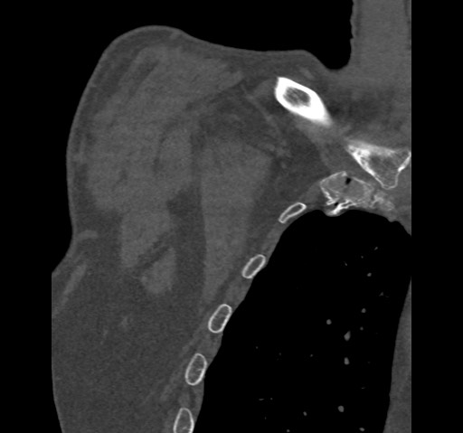 File:Anterior glenohumeral dislocation with Hill-Sachs lesion (Radiopaedia 62877-71249 Coronal bone window 4).jpg