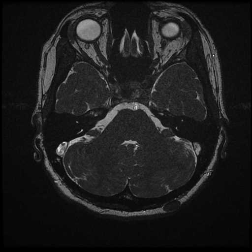 Anterior inferior cerebellar artery vascular loop - type II (Radiopaedia 70991-81209 Axial 3D FIESTA 29).jpg