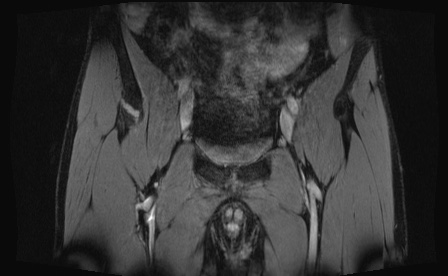 Anterior inferior iliac spine avulsion fracture (Radiopaedia 81312-95000 G 82).jpg