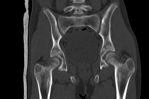 Anterior inferior iliac spine avulsion injury (Radiopaedia 88666-105376 Coronal bone window 42).jpg