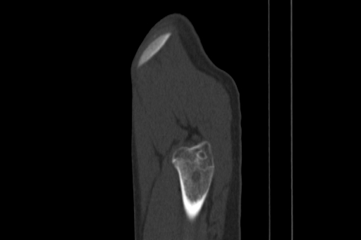 Anterior inferior iliac spine avulsion injury (Radiopaedia 88666-105376 Sagittal bone window 90).jpg