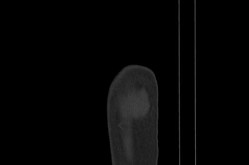 Anterior inferior iliac spine avulsion injury (Radiopaedia 88666-105376 Sagittal bone window 98).jpg