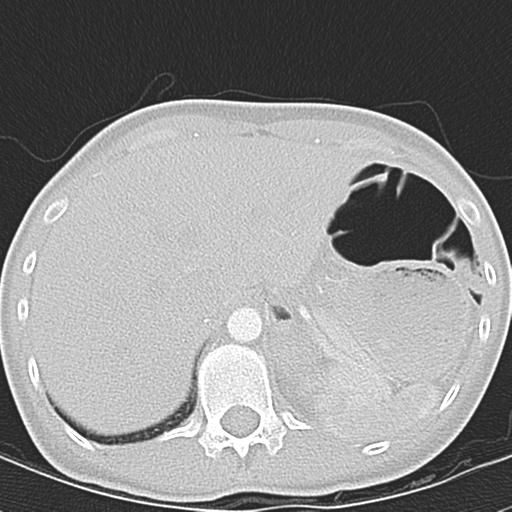 Anterior mediastinal lymphoma (Radiopaedia 29556-30061 Axial lung window 52).jpg