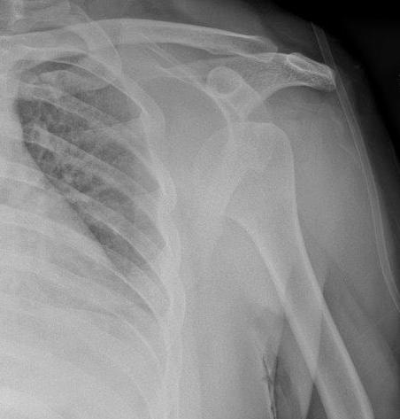 File:Anterior shoulder dislocation (Radiopaedia 46806).jpg
