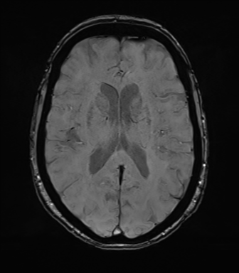 Anterior temporal pole cysts (Radiopaedia 46629-51102 Axial SWI 51).png
