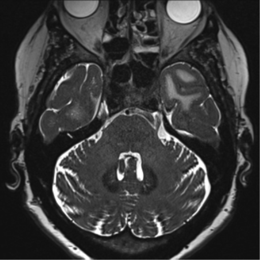 Anterior temporal pole cysts (Radiopaedia 46629-51102 Axial T2 44).png