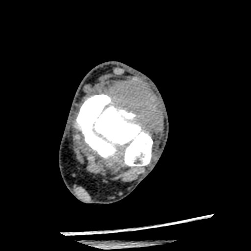 Anterior tibial artery false aneurysm (Radiopaedia 88984-105809 A 117).jpg