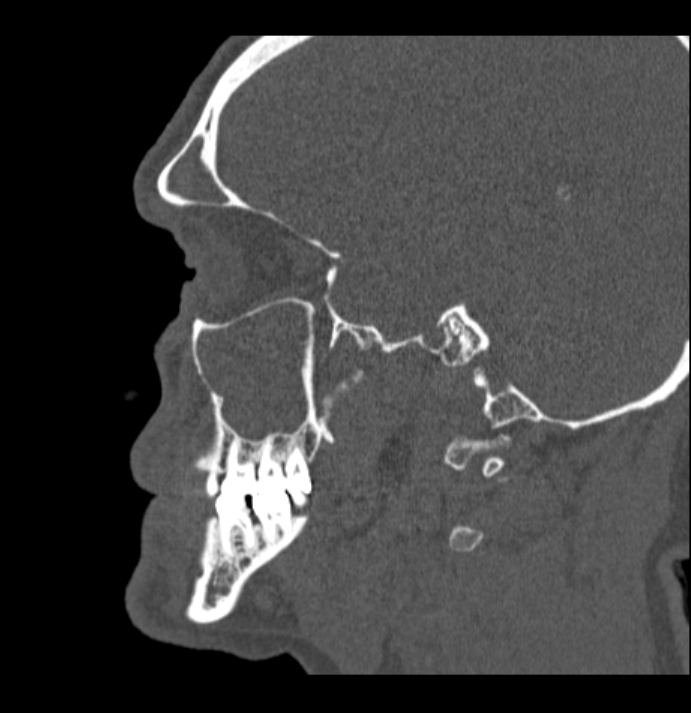 Antrochoanal polyp (Radiopaedia 79011-92169 Sagittal bone window 55).jpg