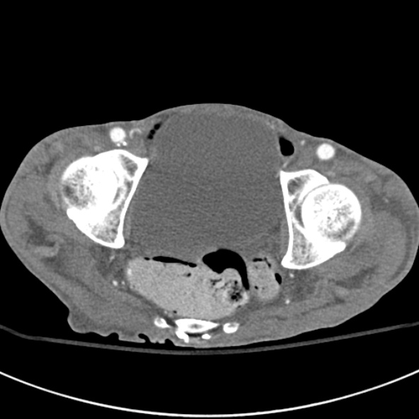 File:Aortic aneurysm with spinal destruction (Radiopaedia 42301-45410 A 102).jpg
