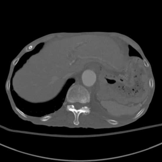 Aortic aneurysm with spinal destruction (Radiopaedia 42301-45410 Axial bone window 16).jpg