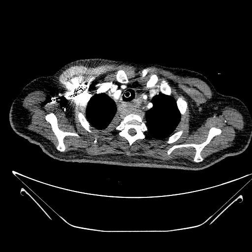 Aortic arch aneurysm (Radiopaedia 84109-99365 B 102).jpg