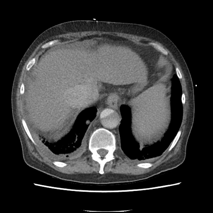 Aortic arch graft infection (FDG PET-CT) (Radiopaedia 71975-82437 A 54).jpg