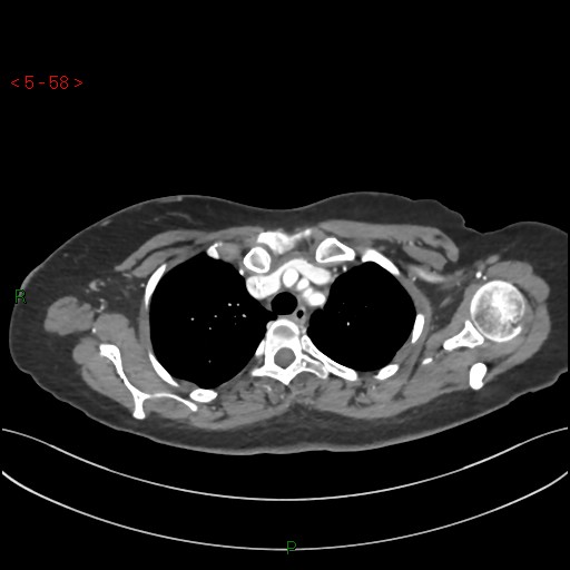File:Aortic arch origin of left vertebral artery (Radiopaedia 51520-57286 A 57).jpg