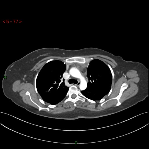 File:Aortic arch origin of left vertebral artery (Radiopaedia 51520-57286 A 76).jpg