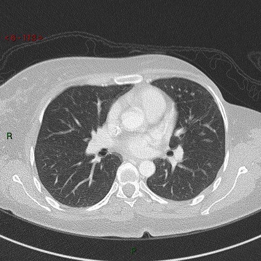 Aortic arch origin of left vertebral artery (Radiopaedia 51520-57286 Axial lung window 113).jpg