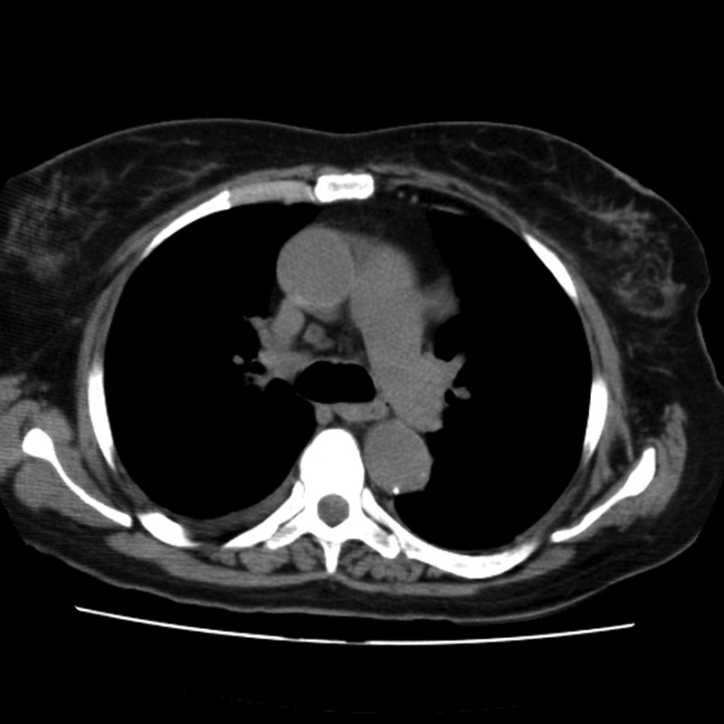 Aortic arch pseudoaneurysm (Radiopaedia 8534-9368 Axial non-contrast 29).jpg