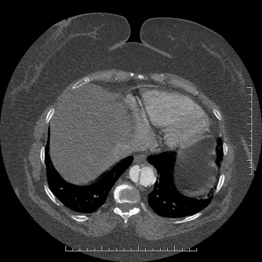 File:Aortic dissection- Stanford A (Radiopaedia 35729-37268 B 13).jpg