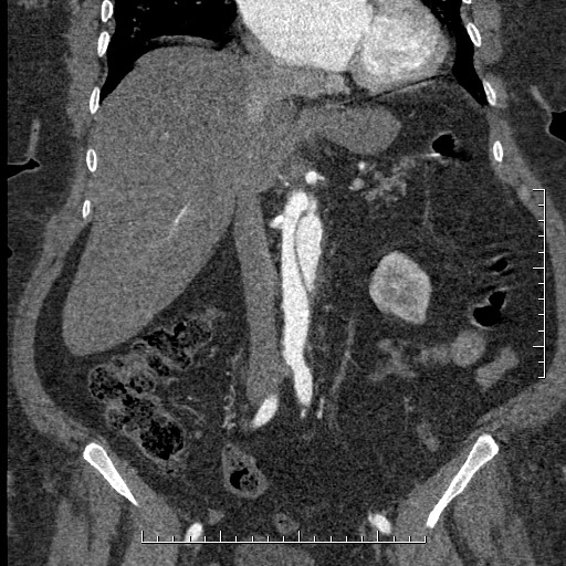 Aortic dissection- Stanford A (Radiopaedia 35729-37268 F 34).jpg