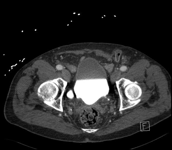 Aortic dissection (CTPA) (Radiopaedia 75506-86750 E 139).jpg