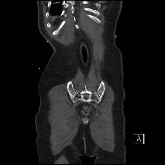 File:Aortic dissection (CTPA) (Radiopaedia 75506-86750 F 70).jpg