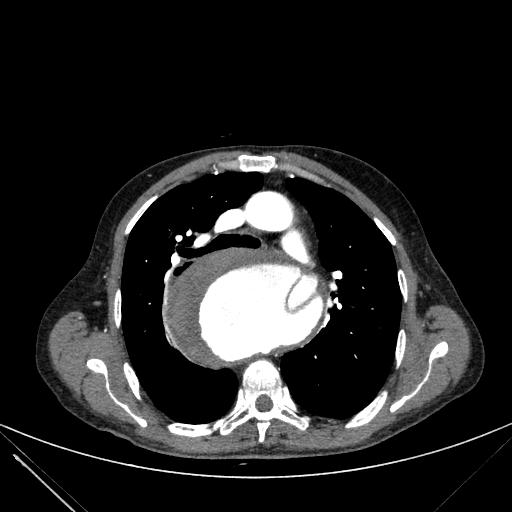 Aortic dissection (Radiopaedia 27466-27665 C+ arterial phase 86).jpg