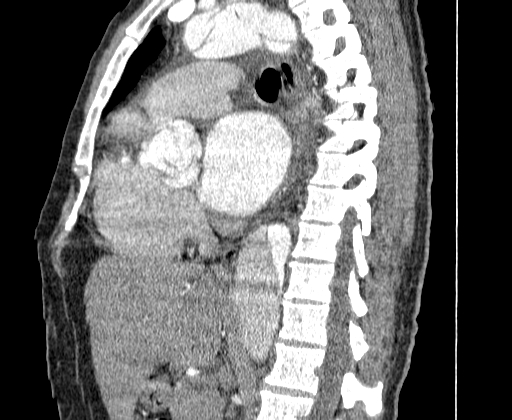 File:Aortic dissection - Stanford A -DeBakey I (Radiopaedia 28339-28587 C 32).jpg