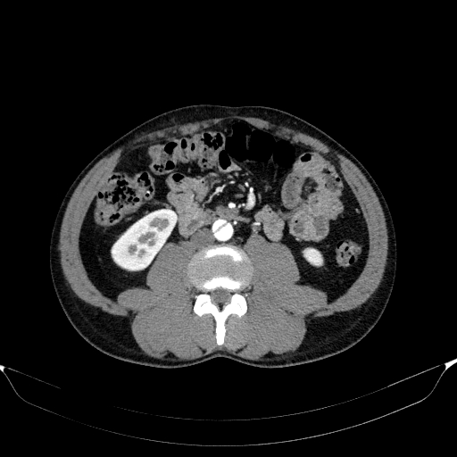 File:Aortic dissection - Stanford type A (Radiopaedia 83418-98500 A 84).jpg