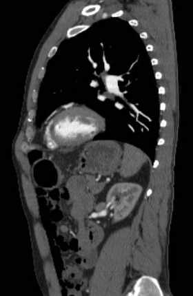 File:Aortic dissection - Stanford type B (Radiopaedia 73648-84437 C 49).jpg