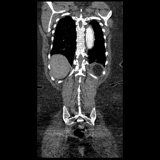 File:Aortic dissection - Stanford type B (Radiopaedia 88281-104910 B 74).jpg