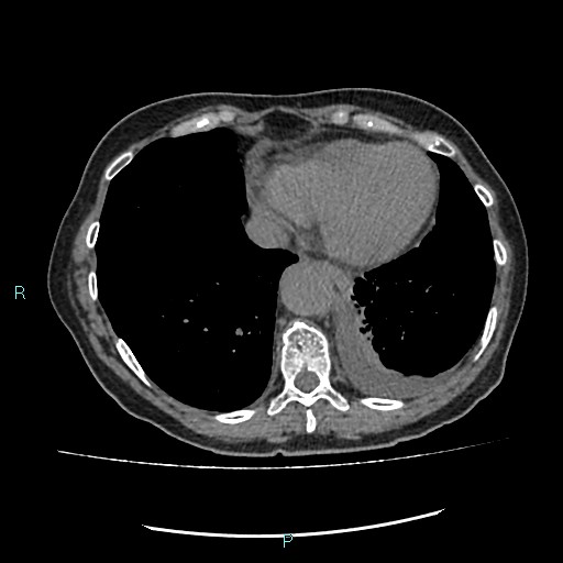 File:Aortic dissection extended to lusory artery (Radiopaedia 43686-47136 Axial non-contrast 22).jpg