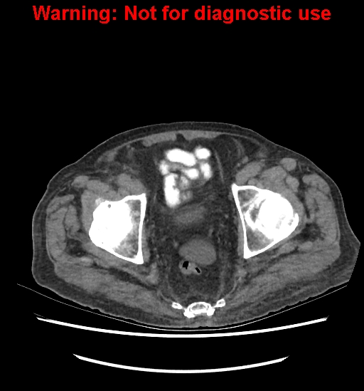 Aortic graft infection (Radiopaedia 44979-48907 Axial non-contrast 85).jpg