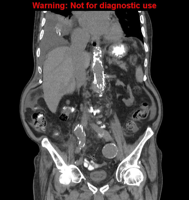 Aortic graft infection (Radiopaedia 44979-48907 non-contrast 27).jpg
