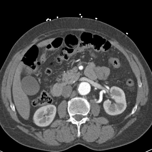 Aortic intramural hematoma (Radiopaedia 31139-31838 B 101).jpg