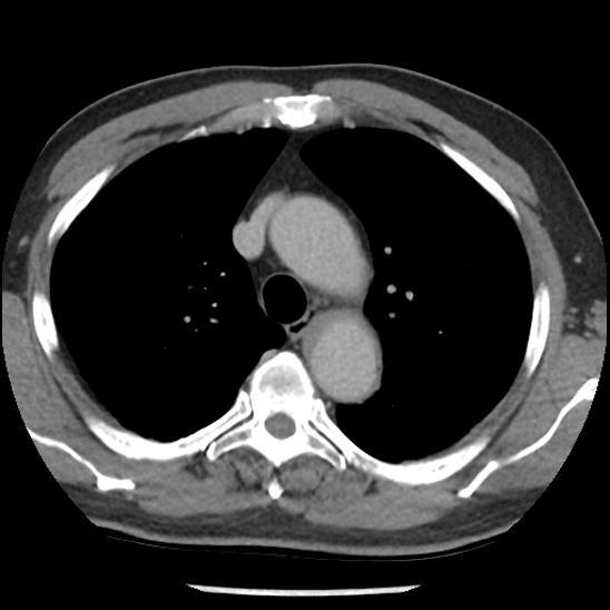 Aortic intramural hematoma (type B) (Radiopaedia 79323-92387 Axial C+ delayed 15).jpg