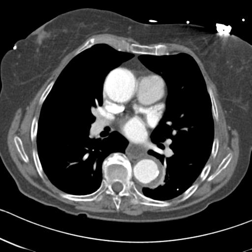 Aortic intramural hematoma from penetrating atherosclerotic ulcer (Radiopaedia 31137-31836 A 42).jpg