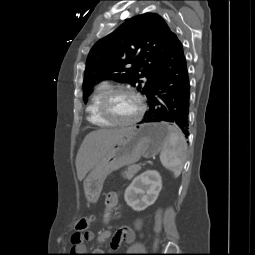 File:Aortic intramural hematoma from penetrating atherosclerotic ulcer (Radiopaedia 31137-31836 B 4).jpg