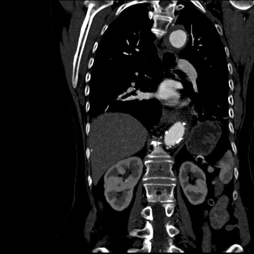 File:Aortic intramural hematoma from penetrating atherosclerotic ulcer (Radiopaedia 31137-31836 C 42).jpg