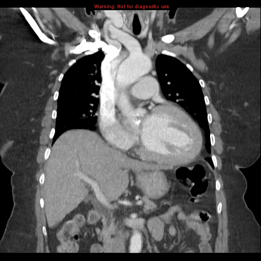 File:Aortic valve stenosis (Radiopaedia 14480-14423 A 10).jpg