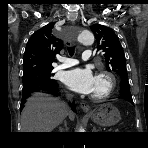 File:Aorto-coronary bypass graft aneurysms (Radiopaedia 40562-43157 B 23).png