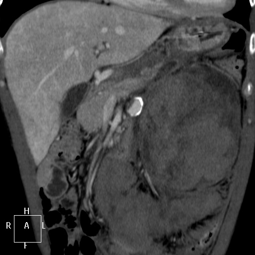 Aorto-left renal vein fistula (Radiopaedia 45534-49628 B 14).jpg
