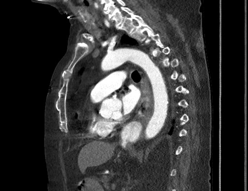 File:Aortoesophageal fistula with endovascular repair (Radiopaedia 73781-84592 Sagittal C+ CTPA 112).jpg