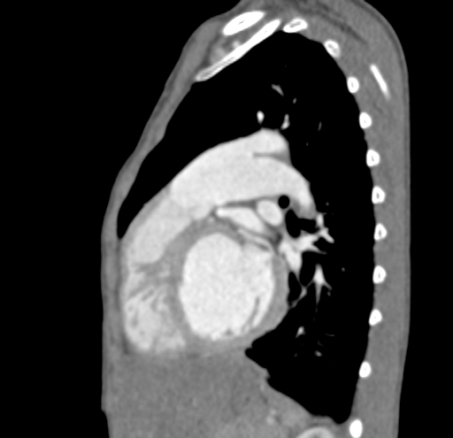 File:Aortopulmonary window, interrupted aortic arch and large PDA giving the descending aorta (Radiopaedia 35573-37074 C 32).jpg