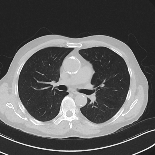 Apical pulmonary metastasis (Radiopaedia 46338-50754 Axial non-contrast 30).png