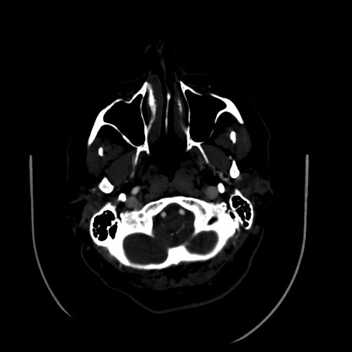 Aplasia of the internal carotid artery (Radiopaedia 61082-68960 A 9).jpg